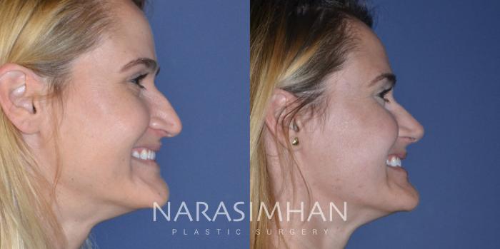 Before & After Rhinoplasty Case 201 View #1 View in Tampa, Florida