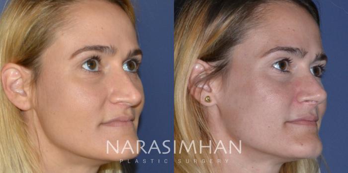 Before & After Rhinoplasty Case 201 View #2 View in Tampa, Florida