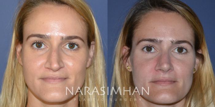 Before & After Rhinoplasty Case 201 View #3 View in Tampa, Florida