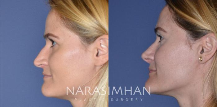 Before & After Rhinoplasty Case 201 View #4 View in Tampa, Florida