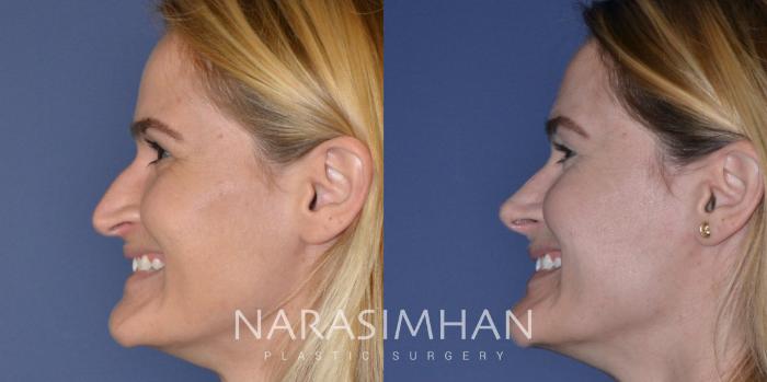 Before & After Rhinoplasty Case 201 View #5 View in Tampa, Florida