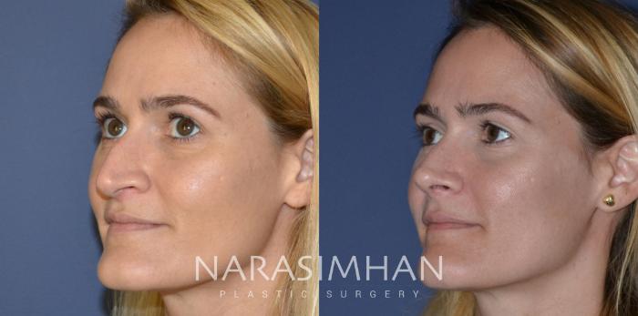 Before & After Rhinoplasty Case 201 View #6 View in Tampa, Florida