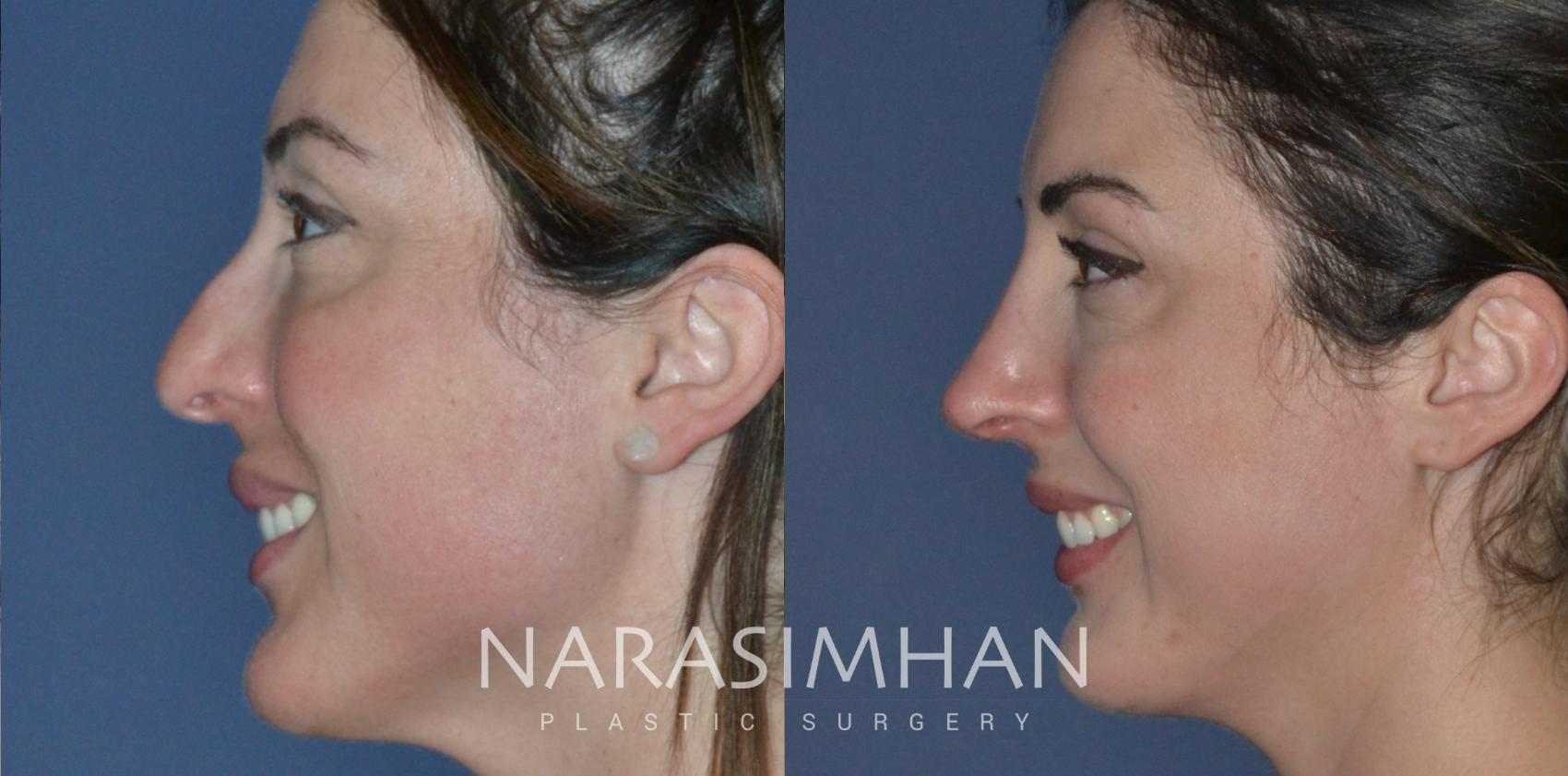 Before & After Revision Rhinoplasty Case 204 View #1 View in St Petersburg, Florida