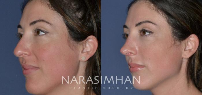Before & After Revision Rhinoplasty Case 204 View #3 View in Tampa, Florida