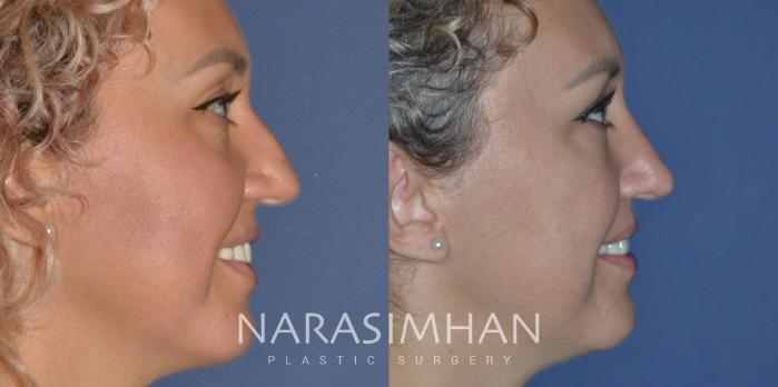 Before & After Rhinoplasty Case 206 View #1 View in Tampa, Florida