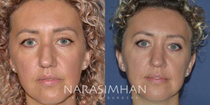 Before & After Rhinoplasty Case 206 View #2 View in Tampa, Florida
