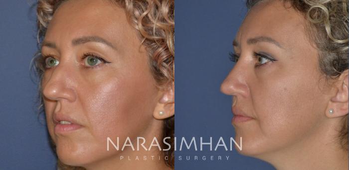 Before & After Rhinoplasty Case 206 View #3 View in Tampa, Florida