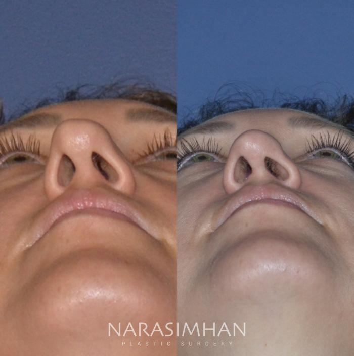 Before & After Ethnic Rhinoplasty Case 206 View #4 View in Tampa, Florida