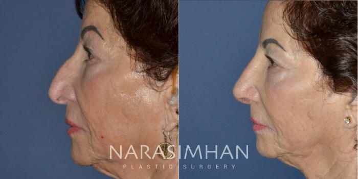 Before & After Rhinoplasty Case 207 View #1 View in Tampa, Florida
