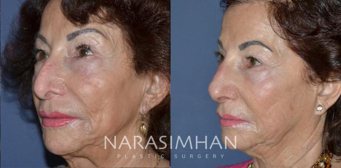 Before & After Rhinoplasty Case 207 View #2 View in Tampa, Florida