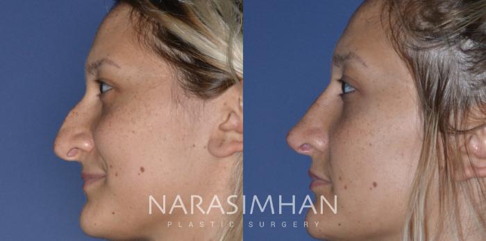 Before & After Rhinoplasty Case 209 View #1 View in Tampa, Florida