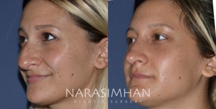 Before & After Rhinoplasty Case 209 View #2 View in Tampa, Florida