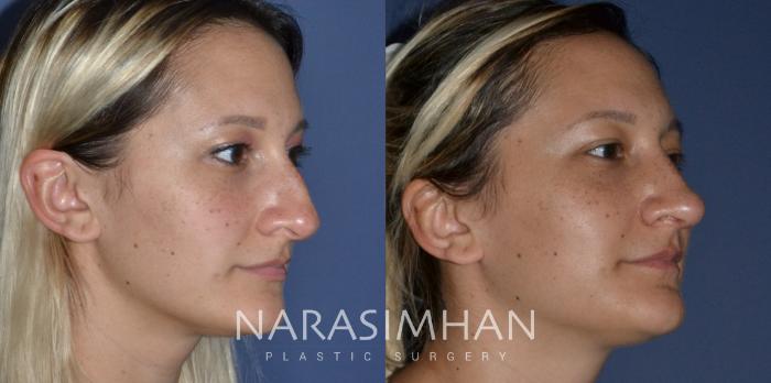 Before & After Rhinoplasty Case 209 View #3 View in Tampa, Florida