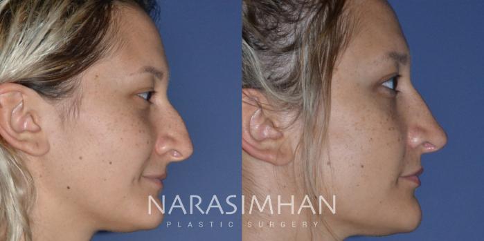 Before & After Rhinoplasty Case 209 View #4 View in Tampa, Florida