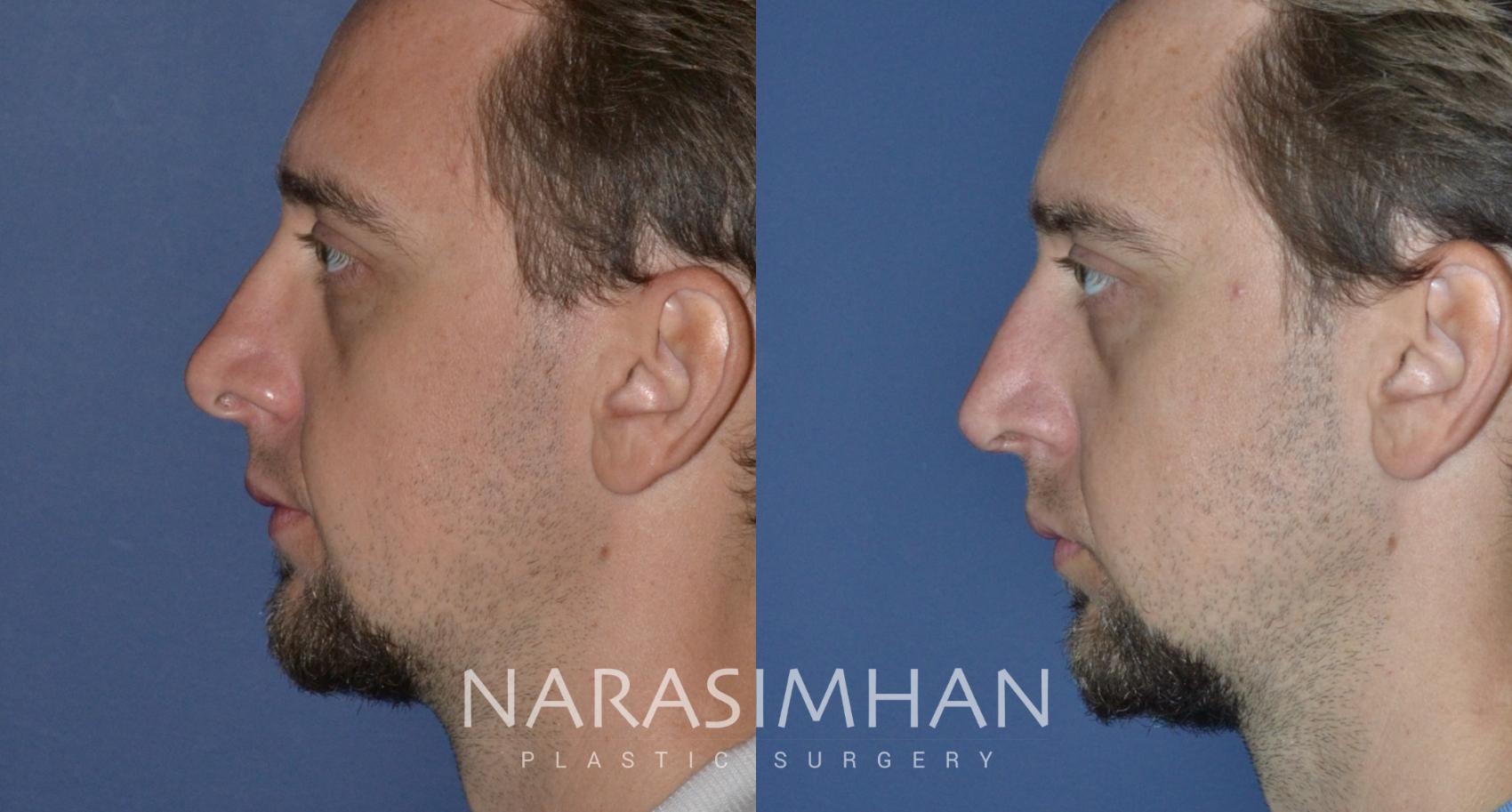 Before & After Revision Rhinoplasty Case 217 View #1 View in Tampa, Florida