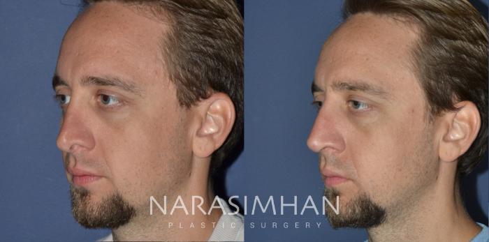 Before & After Rhinoplasty Case 217 View #2 View in St Petersburg, Florida