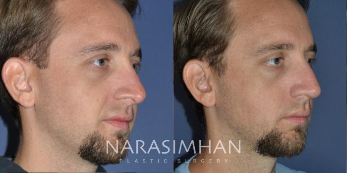 Before & After Rhinoplasty Case 217 View #3 View in St Petersburg, Florida