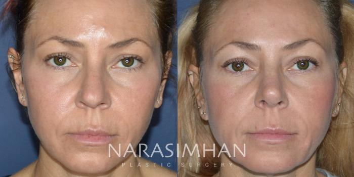 Before & After Rhinoplasty Case 220 View #2 View in St Petersburg, Florida