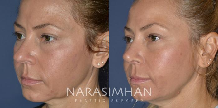 Before & After Rhinoplasty Case 220 View #3 View in St Petersburg, Florida