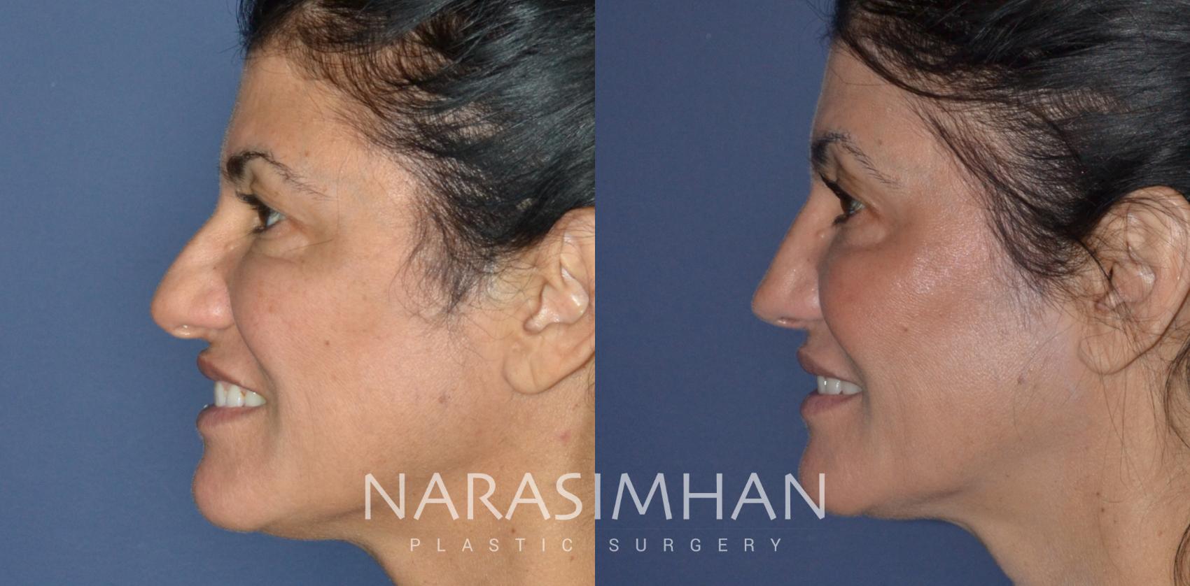 Before & After Rhinoplasty Case 223 View #1 View in Tampa, Florida