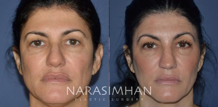 Before & After Rhinoplasty Case 223 View #2 View in Tampa, Florida