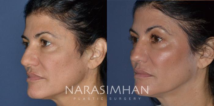 Before & After Rhinoplasty Case 223 View #3 View in Tampa, Florida