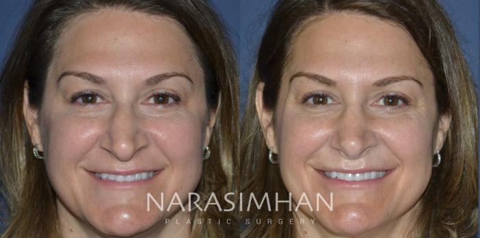 Before & After Rhinoplasty Case 229 View #2 View in Tampa, Florida