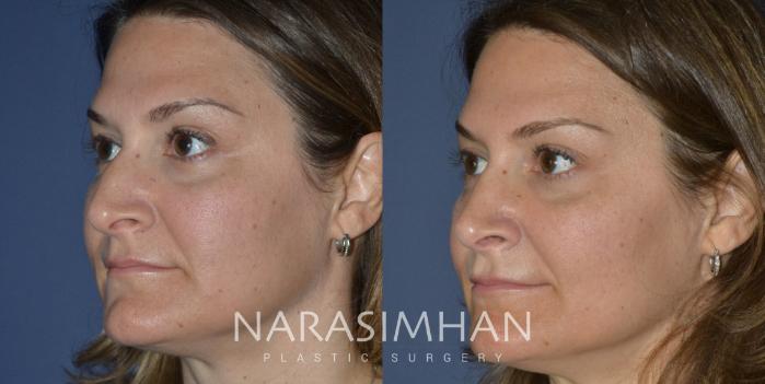 Before & After Rhinoplasty Case 229 View #3 View in Tampa, Florida