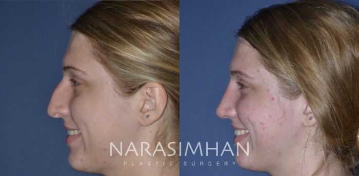 Before & After Rhinoplasty Case 230 View #1 View in Tampa, Florida