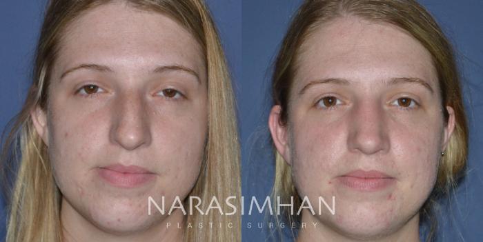 Before & After Rhinoplasty Case 230 View #2 View in Tampa, Florida