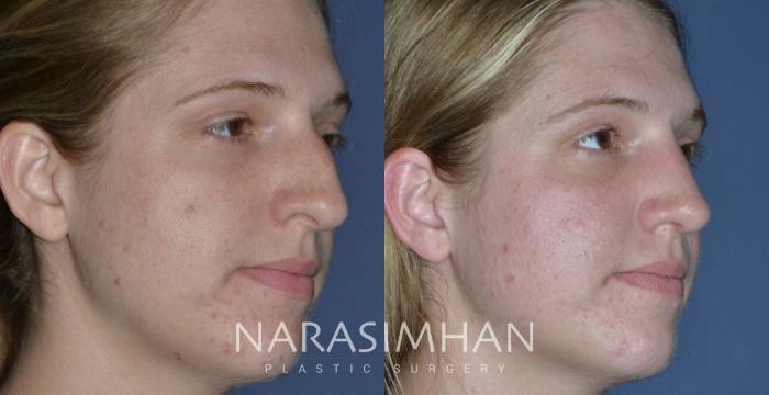Before & After Rhinoplasty Case 230 View #3 View in Tampa, Florida