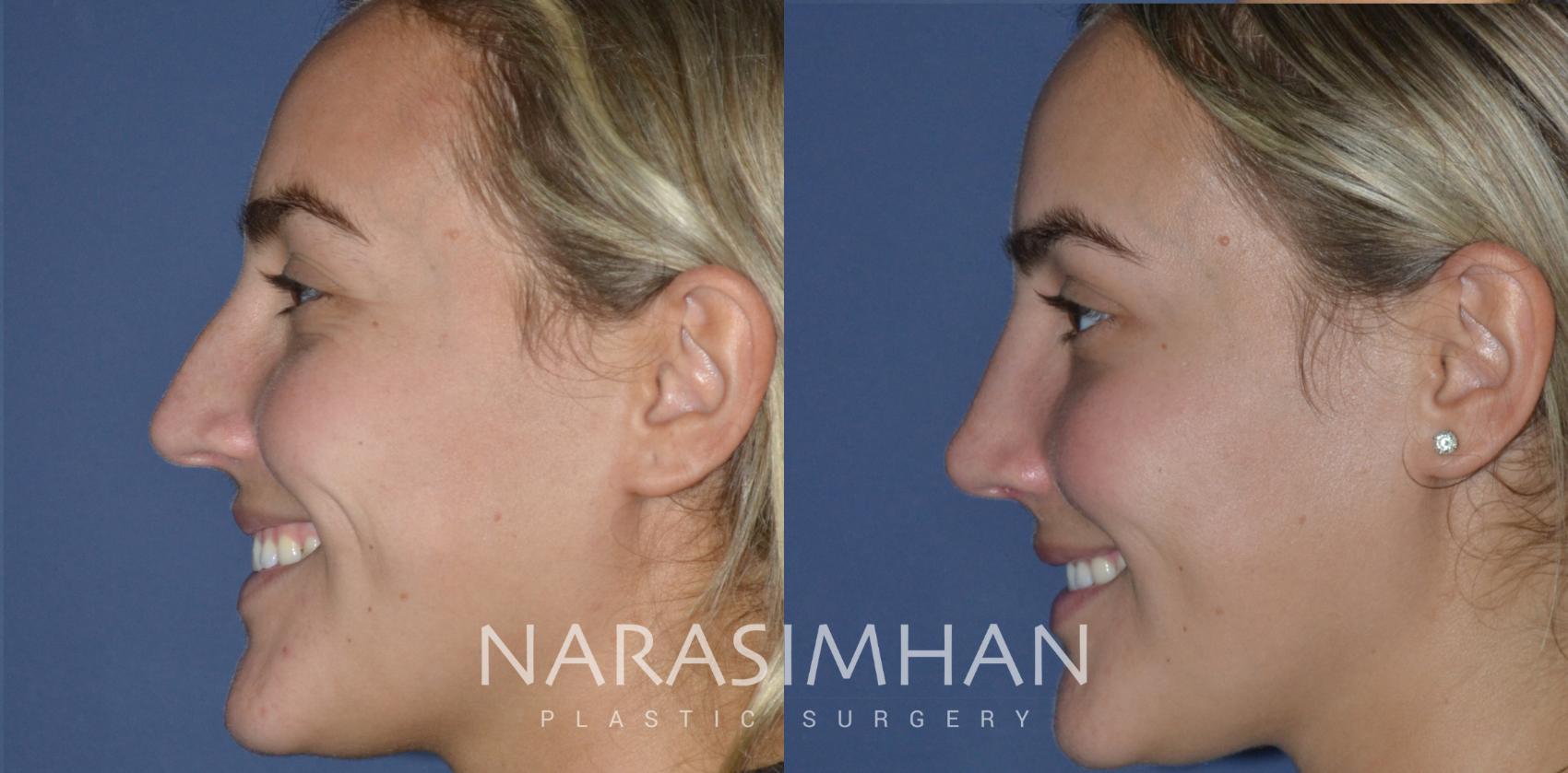 Before & After Rhinoplasty Case 231 View #1 View in Tampa, Florida
