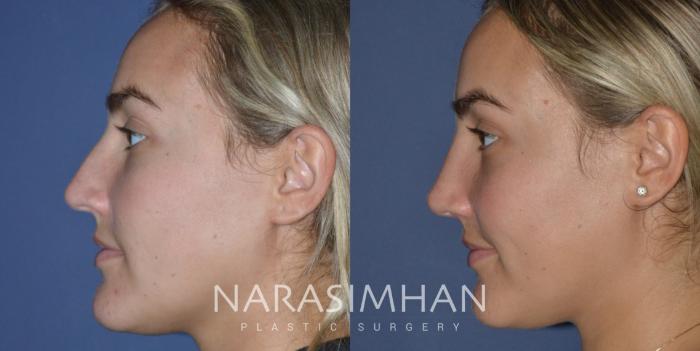 Before & After Rhinoplasty Case 231 View #2 View in Tampa, Florida