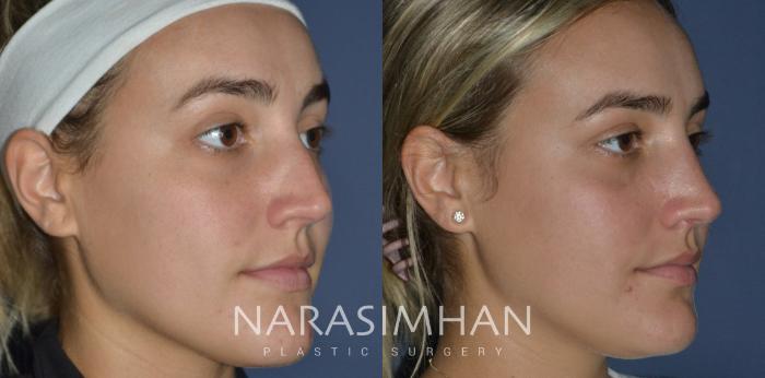 Before & After Rhinoplasty Case 231 View #3 View in Tampa, Florida