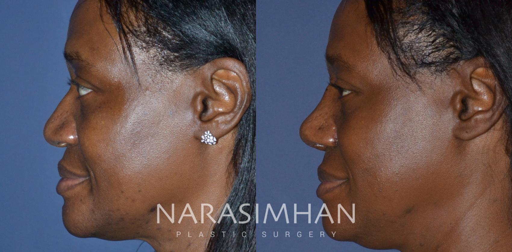 Before & After Rhinoplasty Case 233 View #1 View in St. Petersburg, Florida