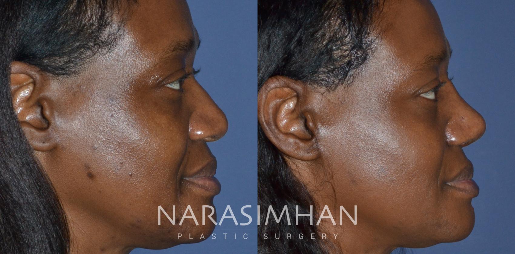 Before & After Rhinoplasty Case 233 View #2 View in St. Petersburg, Florida