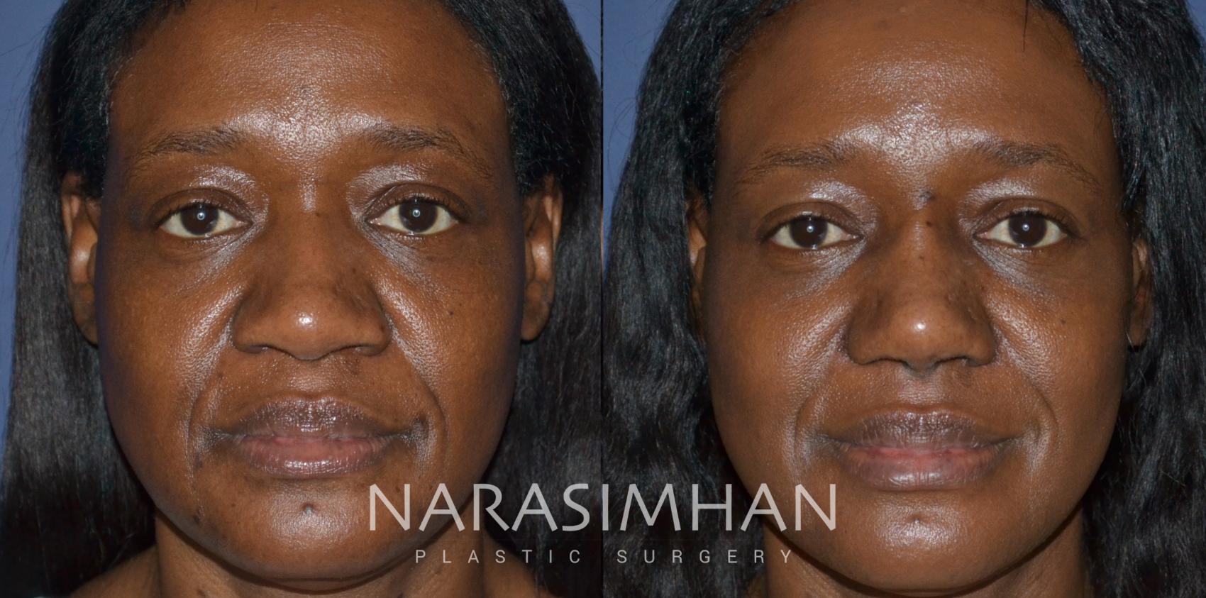 Before & After Rhinoplasty Case 233 View #3 View in St. Petersburg, Florida