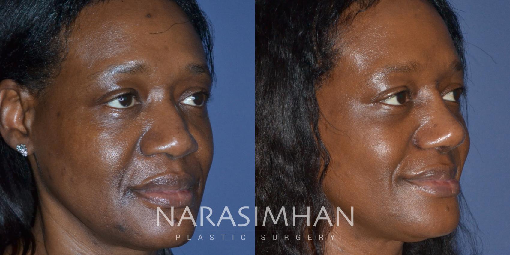 Before & After Rhinoplasty Case 233 View #4 View in St. Petersburg, Florida