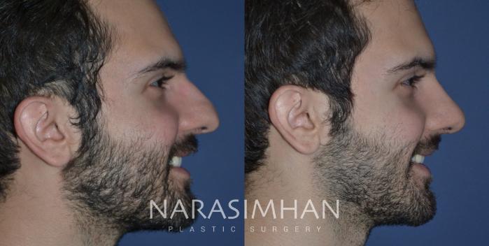 Before & After Rhinoplasty Case 234 View #1 View in Tampa, Florida