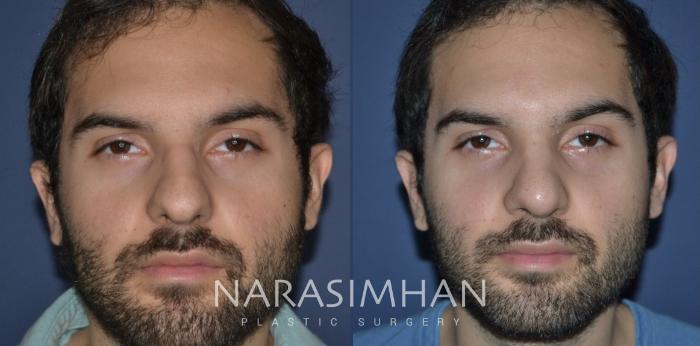 Before & After Ethnic Rhinoplasty Case 234 View #2 View in Tampa, Florida