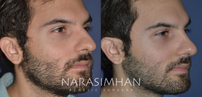 Before & After Rhinoplasty Case 234 View #3 View in Tampa, Florida