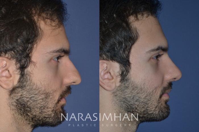 Before & After Rhinoplasty Case 234 View #4 View in Tampa, Florida