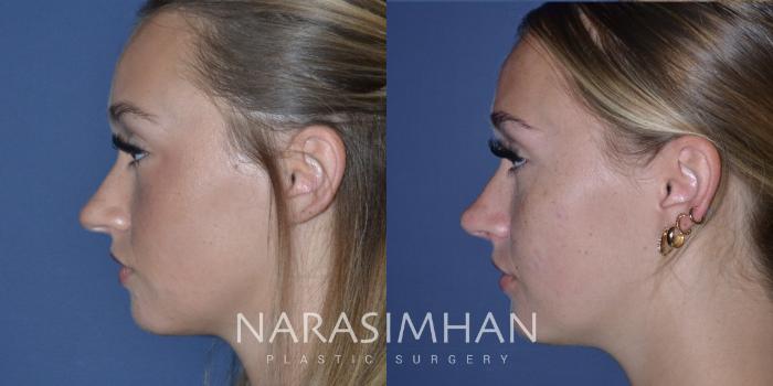 Before & After Rhinoplasty Case 237 View #1 View in Tampa, Florida