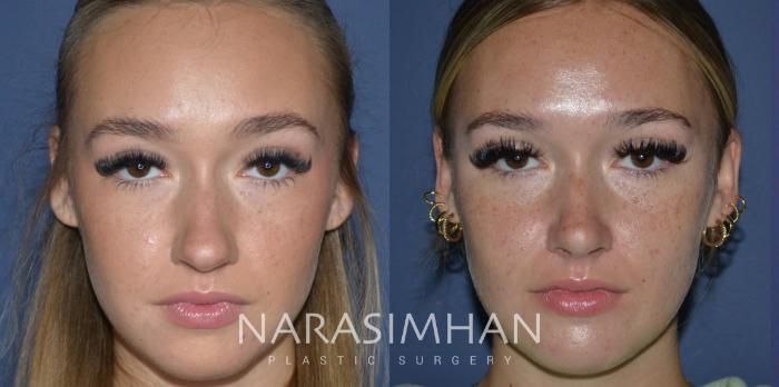 Before & After Rhinoplasty Case 237 View #2 View in Tampa, Florida
