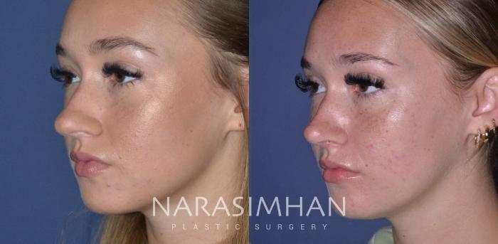Before & After Rhinoplasty Case 237 View #3 View in Tampa, Florida