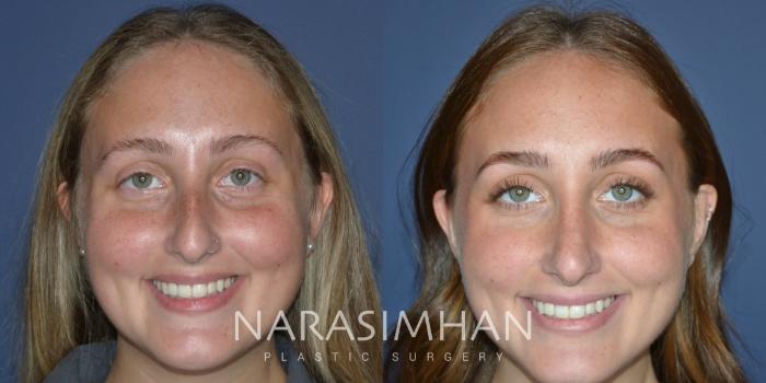 Before & After Rhinoplasty Case 243 Front View in Tampa, Florida