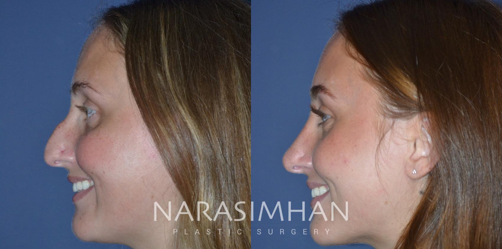 Before & After Rhinoplasty Case 243 Left Side View in Tampa, Florida