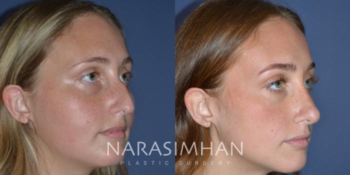 Before & After Rhinoplasty Case 243 Right Oblique View in Tampa, Florida