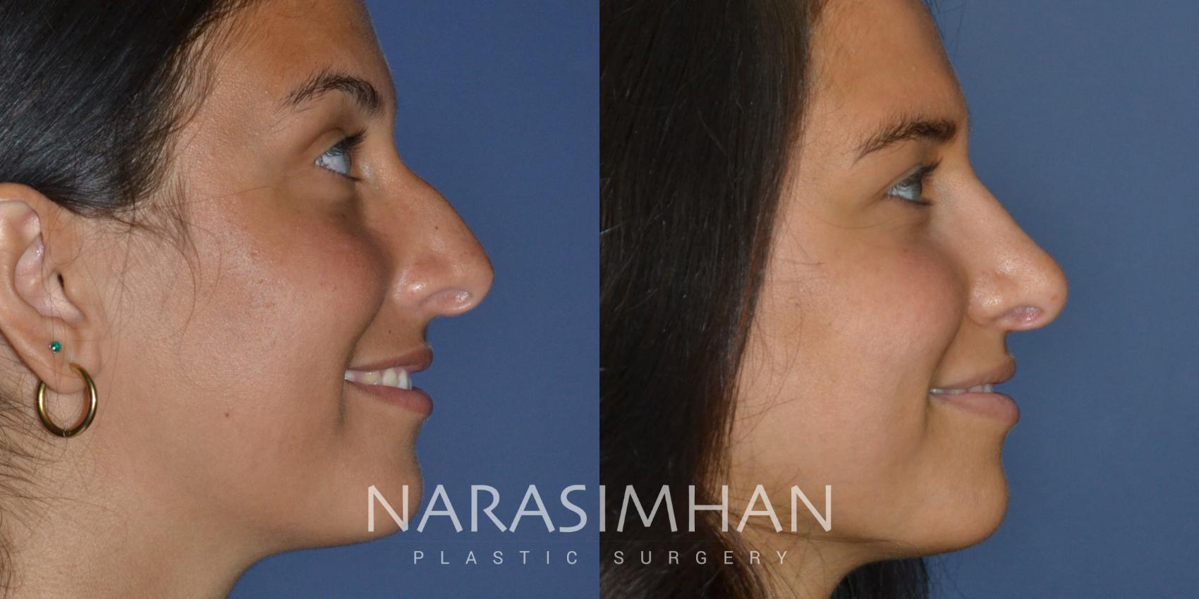 Before & After Rhinoplasty Case 246 View #1 View in St Petersburg, Florida