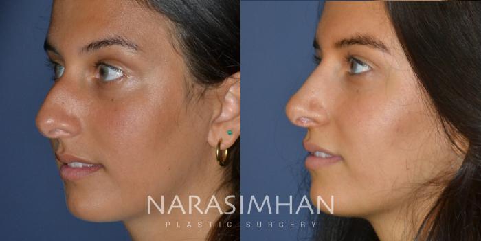 Before & After Rhinoplasty Case 246 View #2 View in Tampa, Florida